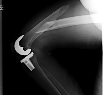 TKR Femoral Fracture